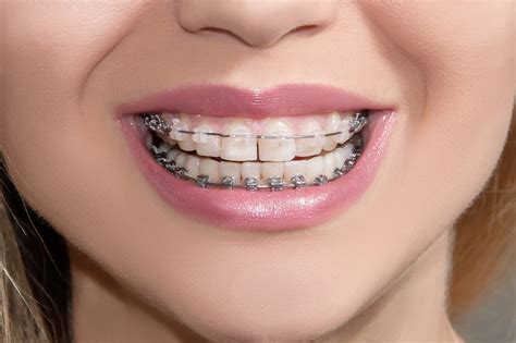 types of braces ceramic brackets